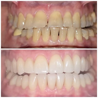 Gutieră dentară transparentă pentru bruxism