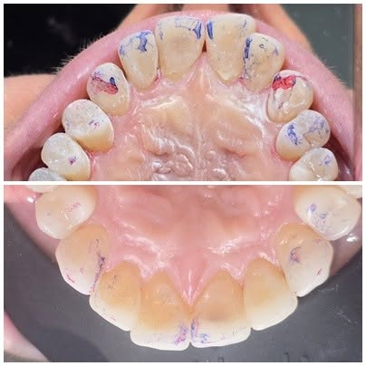 Tipuri de gutiere dentare
