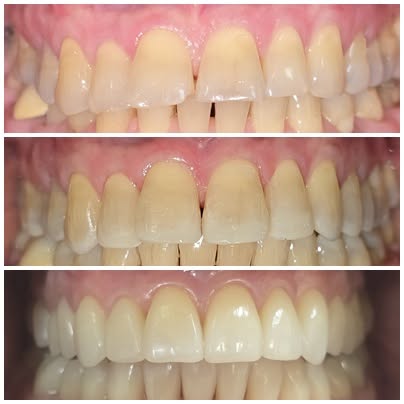 Gutieră dentară realizată la HDS Câmpina